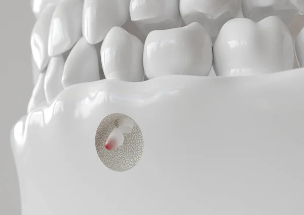 Apikektomi ile kök ucu iltihabı - 3d render