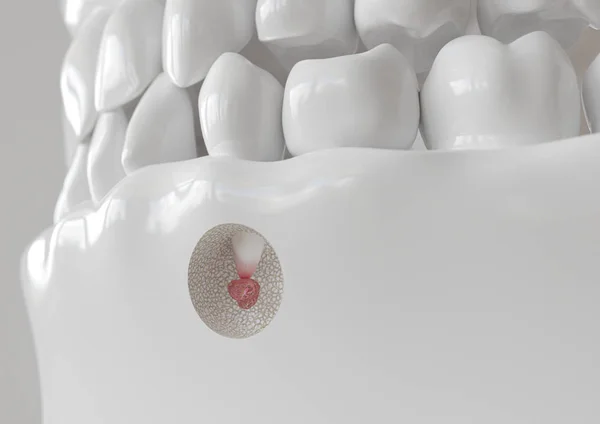 Apikektomi ile kök ucu iltihabı - 3d render