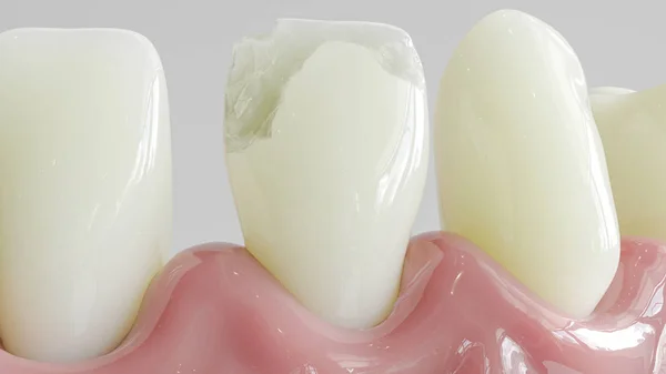 Dente con attacco di carie in primo piano - Rendering 3D — Foto Stock