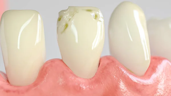 Ząb z próchnicą ataku w zbliżenie-3D rendering — Zdjęcie stockowe