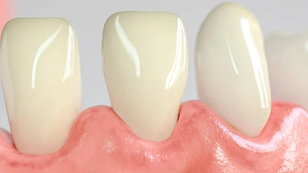 Dente con attacco di carie in primo piano - Rendering 3D — Foto Stock