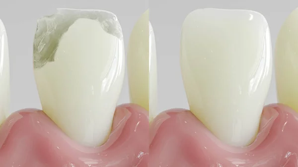クローズアップ-3Dレンダリングとしての齲齲アの治療後の歯 — ストック写真