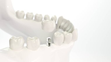 Bir çene modeli örneğinde diş implantı - 3B oluşturma