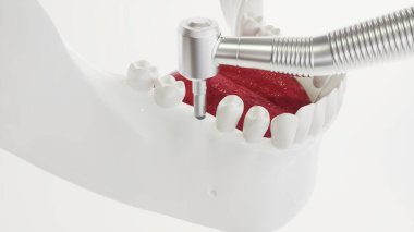 Bir çene modeli örneğinde diş implantı - 3B oluşturma