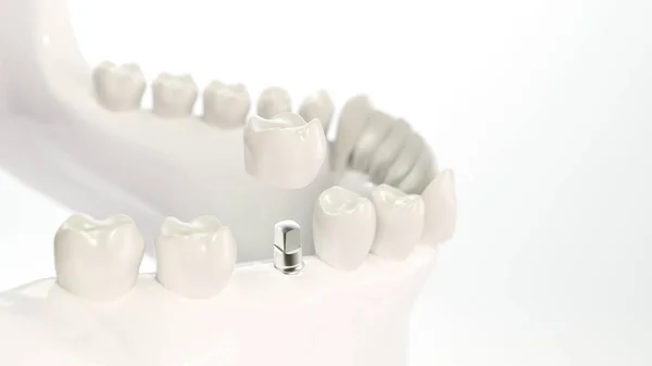 顎モデルの例に歯科インプラント 3Dレンダリング — ストック写真