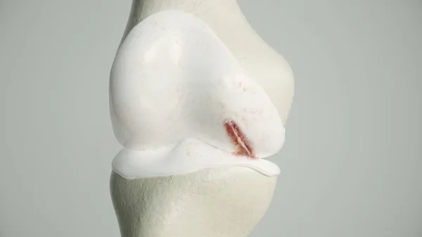 Milde Artrose Het Kniegewricht Rendering — Stockfoto