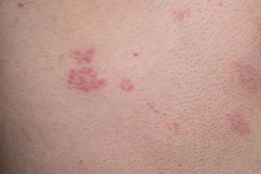 Shingles disease, herpes zoster, blisters on body, varicella-zoster virus, skin rash clipart