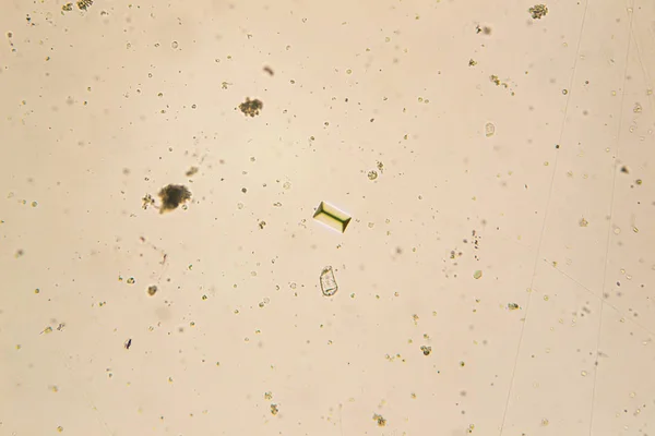 Struvites at the microscope. Urine sample from a dog who urinate frequently — Stock Photo, Image