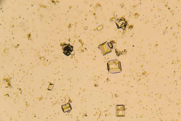 Vizelet kristályok, vörösvértestek és fehérvérsejtek, a Mikroszkóp — Stock Fotó