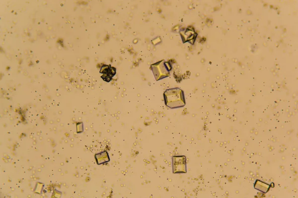 Vizelet kristályok, vörösvértestek és fehérvérsejtek, a Mikroszkóp — Stock Fotó