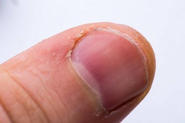 Erkek parmağı yakın, kuru manikül, çatlamış deri. bir ma bir parmak