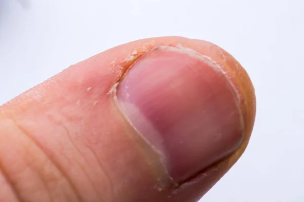 Man finger närbild, torr nagelband, narig hud. ett finger av en MA — Stockfoto