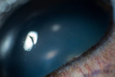 katarakt ile yaşlı köpek gözü