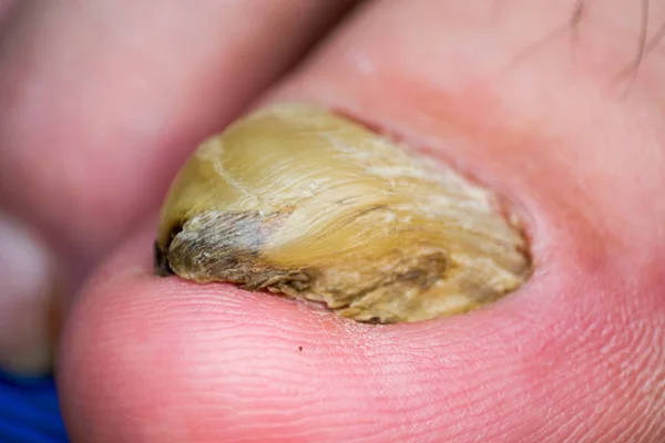 Makro zdjęcie ludzkiego paznokieć z zakażeniem grzybiczym — Zdjęcie stockowe