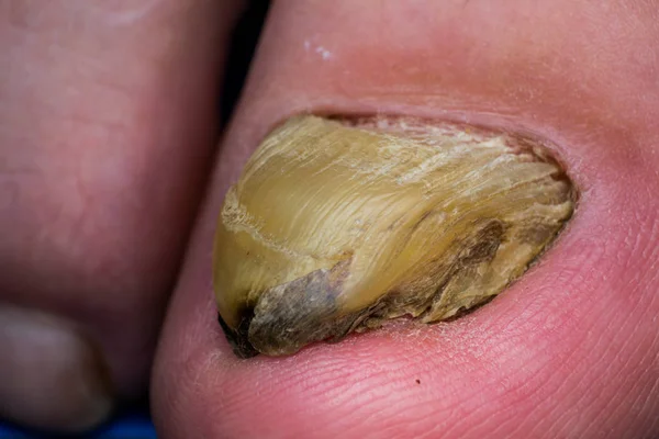 人脚趾甲与真菌的宏观照片 — 图库照片