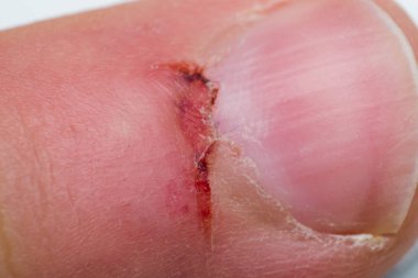 çivi yakın keserek yara