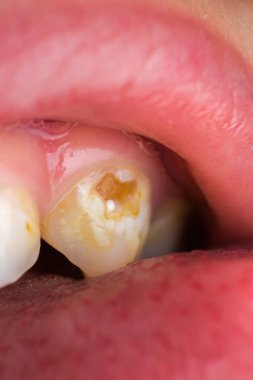 Çocuk hasta ağzını açıp çürük diş gösteriyor. Sağlıksız bebek dişlerini kapatın. Çürük diş makrosu.