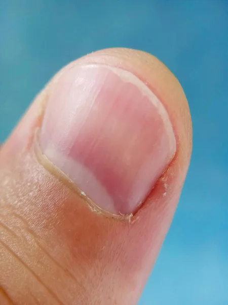 Der Menschliche Finger Aus Nächster Nähe Trockene Nagelhaut Rissige Haut — Stockfoto