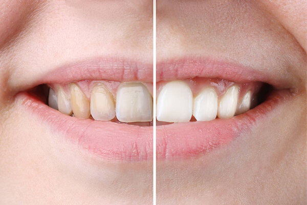 whitening or bleaching treatment ,before and after ,woman teeth and smile, close up, isolated on white