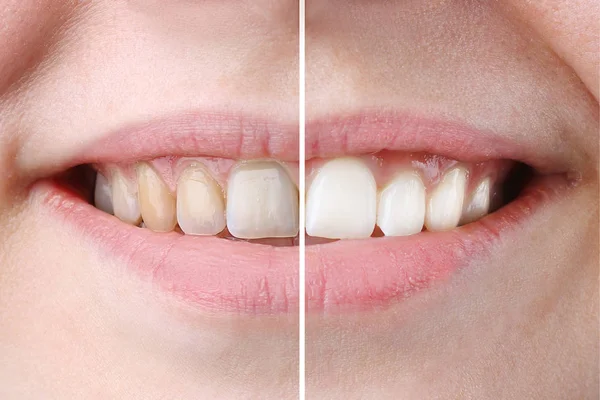 Beyazlatma ya da beyazlatma tedavisi, önce ve sonra, kadın dişleri ve gülümsemesi, kapalı, beyaz üzerinde izole Telifsiz Stok Imajlar