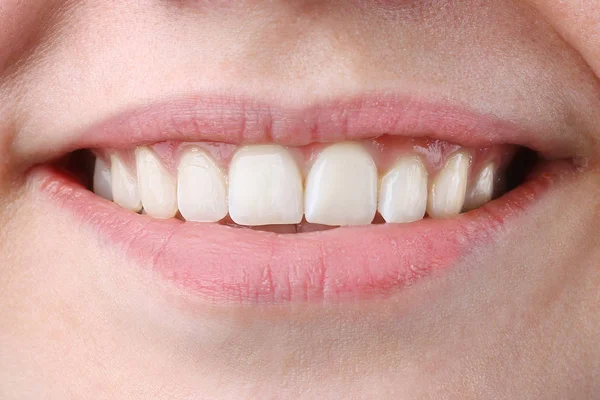 Hermosa mujer joven con dientes sanos sobre fondo blanco. dientes de mujer y sonrisa de cerca —  Fotos de Stock