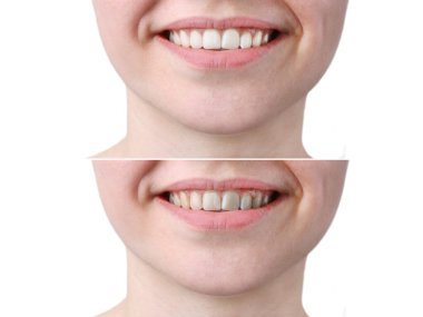 Beyaz arka planda Beyaz Dişler Önce ve Sonra