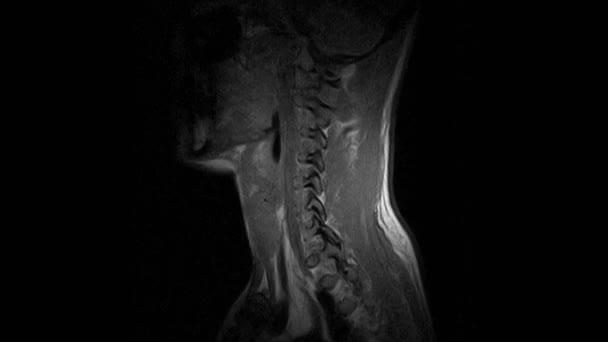 MRT av cervikal ryggrad, detektering av utskjutande delar, utsprång och bråck — Stockvideo