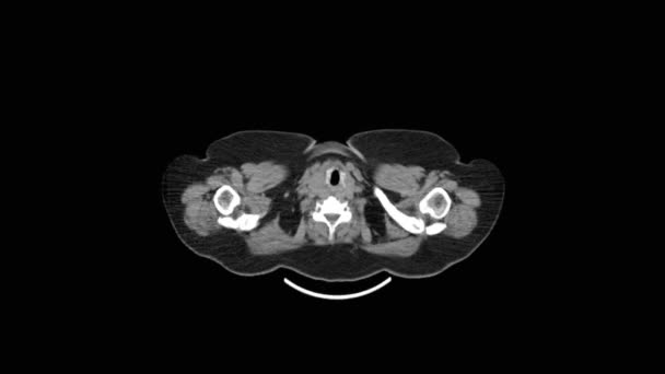 MRI scan of the lungs and bronchi, diagnosis of respiratory diseases — Stock Video