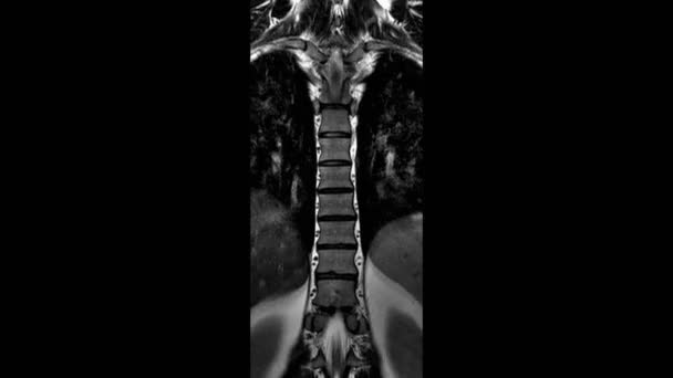 胸脊的Mri扫描，脊柱上突起和羊皮的检测 — 图库视频影像
