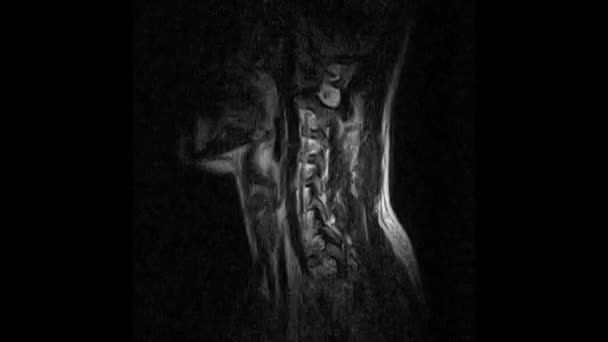 MRI-scan van de cervicale wervelkolom, detectie van uitsteeksels en hernia's op de wervelkolom — Stockvideo