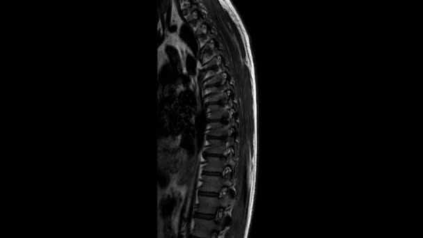Badanie MRI grzbietu piersiowego, wykrywanie występów i przepuknięć na grzbiecie kręgosłupa — Wideo stockowe