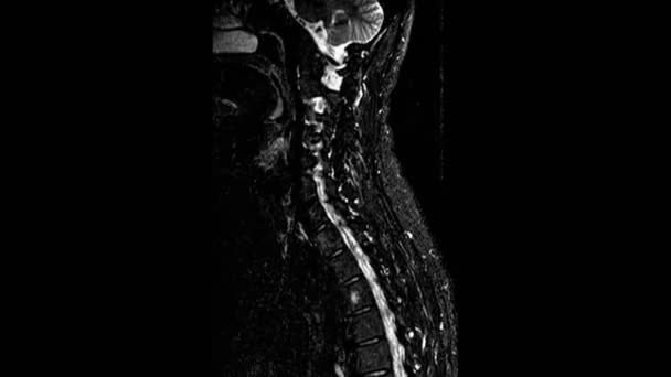 МРТ шийного відділу хребта, виявлення виступів і гриж на хребті — стокове відео