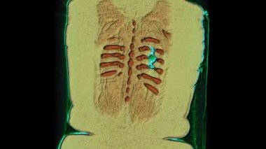 Akciğer ve bronşların 3 boyutlu renk Mri taraması, solunum yolu hastalıklarının tanısı