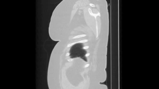 MRI-scan van de longen en bronchiën, diagnose van ademhalingsziekten — Stockvideo