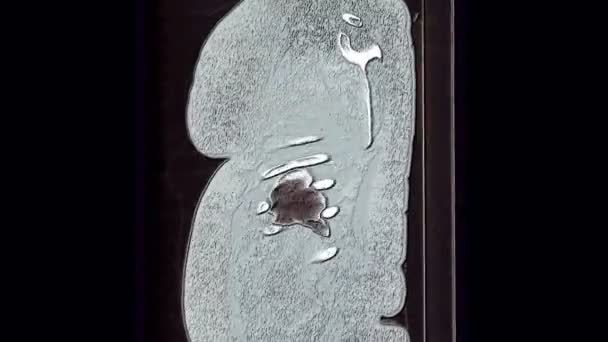肺和支气管的Mri扫描，呼吸系统疾病的诊断 — 图库视频影像