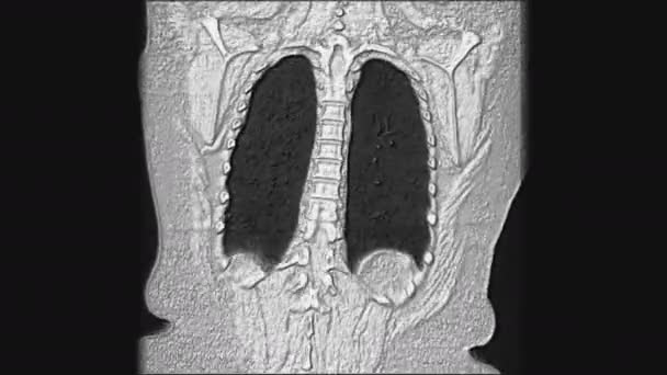 A tüdő és a hörgők térfogatos MRI-je, vírusos vagy kovid-19 légzőszervi betegség diagnózisa — Stock videók