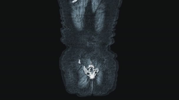 Πυκνό χρώμα MRI της κοιλιακής κοιλότητας, γαστρεντερικού σωλήνα, ουροδόχου κύστης — Αρχείο Βίντεο