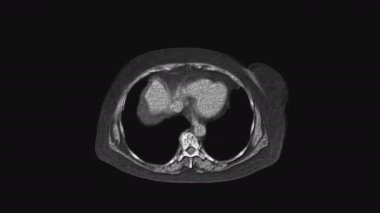 Karın boşluğunun, gastrointestinal bölgenin, mesanenin kaslı MR 'ı.
