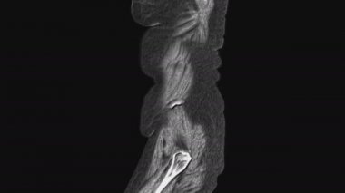 Karın boşluğunun, gastrointestinal bölgenin, mesanenin kaslı MR 'ı.