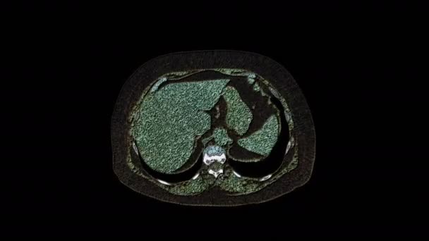 Hromadné mnohobarevné MRI břišní dutiny, gastrointestinálního traktu, močového měchýře — Stock video
