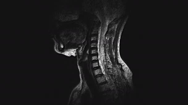 子宮頸椎の大量MRI 、突起とヘルニアの検出 — ストック動画