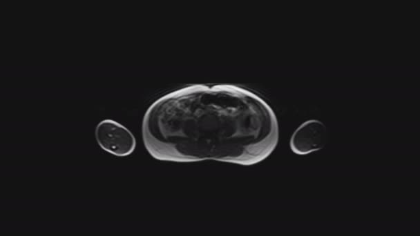 MRI ženských pánevních orgánů, břišní dutiny, gastrointestinálního traktu a močového měchýře — Stock video