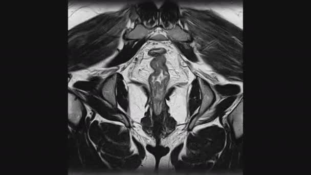 A női medencei szervek, a hasüreg, a gyomor-bélrendszer és a húgyhólyag MRI-je — Stock videók