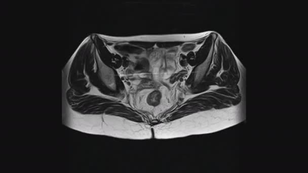 Resonancia magnética de los órganos pélvicos femeninos, cavidad abdominal, tracto gastrointestinal y vejiga — Vídeo de stock
