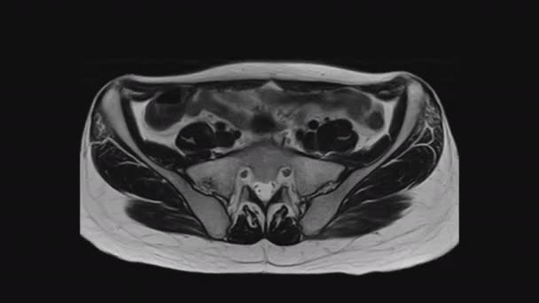 A női medencei szervek, a hasüreg, a gyomor-bélrendszer és a húgyhólyag MRI-je — Stock videók