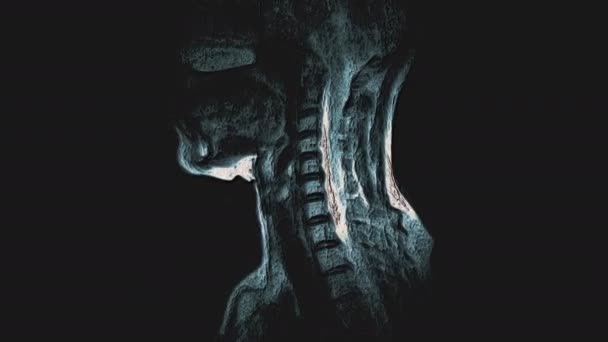 RM multicolore alla rinfusa della colonna vertebrale cervicale, rilevamento di sporgenze ed ernie — Video Stock