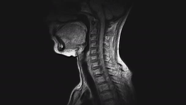 子宮頸椎の大量MRI 、突起とヘルニアの検出 — ストック動画