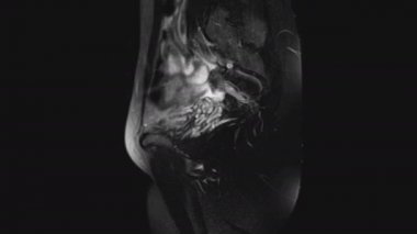 Kadın pelvik organlarının MR 'ı, karın boşluğu, gastrointestinal bölge ve mesane.