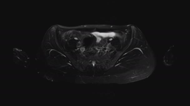 IRM des organes pelviens féminins, cavité abdominale, tractus gastro-intestinal et vessie — Video