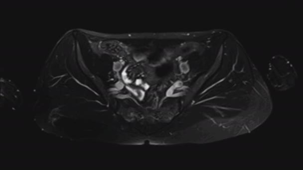 MRT av de kvinnliga bäckenorganen, bukhålan, magtarmkanalen och urinblåsan — Stockvideo